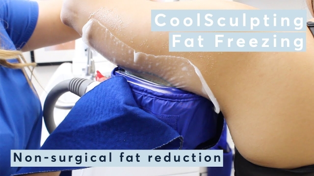 Frost Away Fat: Unveiling the Chilling Benefits of CoolSculpting