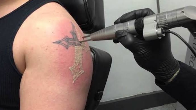 Tattoo Removal Cream Information – Are Tattoo Removal Creams Worth The Money?