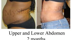 Flaunt your Flawless Figure: The Ultimate Guide to Abdominoplasty