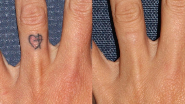 Laser Tattoo Removal Cost And Tattoo Removal Cream Cost