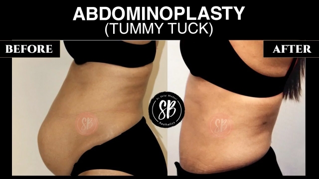 Tummy Tucks: Transforming Your Abdominal Aesthetics