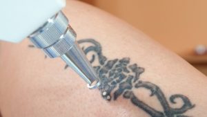 Running Through Reasons For Laser Tattoo Removal