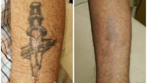 Tattoo Mistakes – Steer Clear Of Them