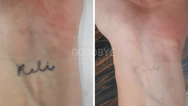 Tattoo Removal – What To Prepare For For Pain, Cost And Results