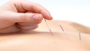 The Art of Healing: Exploring the World of Acupuncture